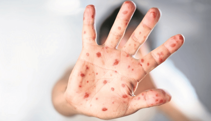 Alerta por nuevos casos de sarampión en el&nbsp;país