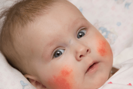 ¿Qué es y cómo afecta la enfermedad de&nbsp;Kawasaki?